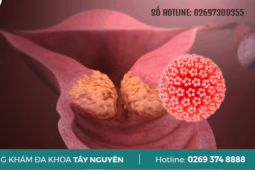 Bệnh Sùi Mào Gà Giai Đoạn 1 Có Tự Khỏi Không Pleiku Gia Lai