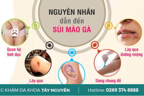 Bệnh Sùi Mào Gà Lây Truyền Qua Đường Nào?