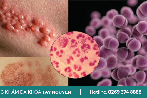 Các Giai Đoạn Phát Triển Bệnh Lậu Đaklak