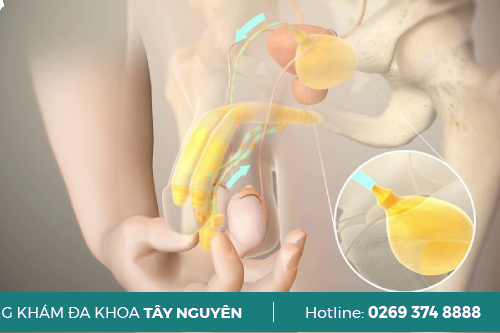 Bệnh liệt dương là gì?