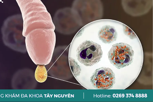 Dương Vật Bị Ngứa Và Chảy Mủ Có Phải Mắc Bệnh Lậu Dương Vật Bị Ngứa Và Chảy Mủ Có Phải Mắc Bệnh Lậu