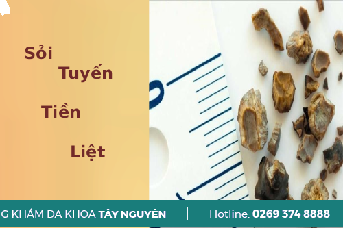 Những Tác Hại Của Bệnh Sỏi Tuyến Tiền Liệt