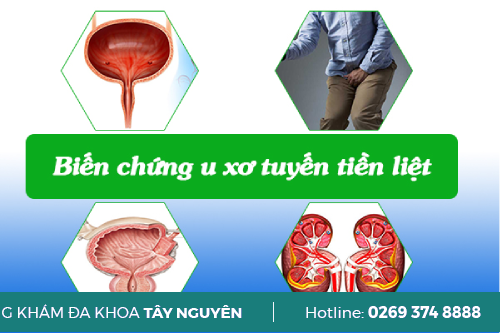 Phương Pháp Mổ U Xơ Tuyến Tiền Liệt Hiệu Qủa Kom Tun 2025