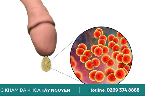 Quan Hệ Bằng Miệng Có Lây Bệnh Lậu Không Gia Lai?