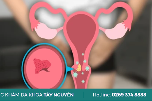 Tìm Hiểu Những Biến Chứng Khủng Khiếp Của Sùi Mào Gà?