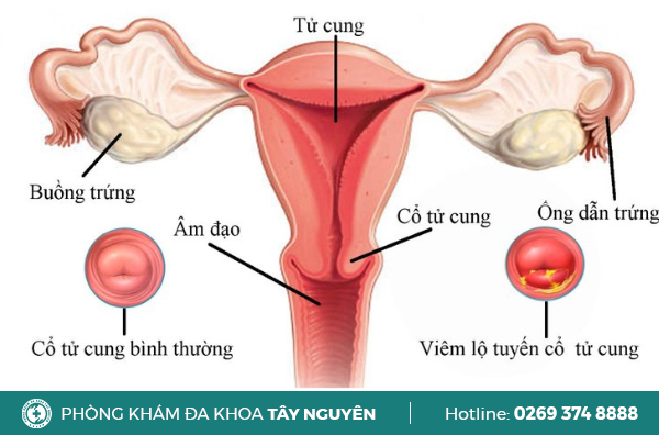 Viêm lộ tuyến cổ tử cung: Dấu hiệu và phương pháp điều trị